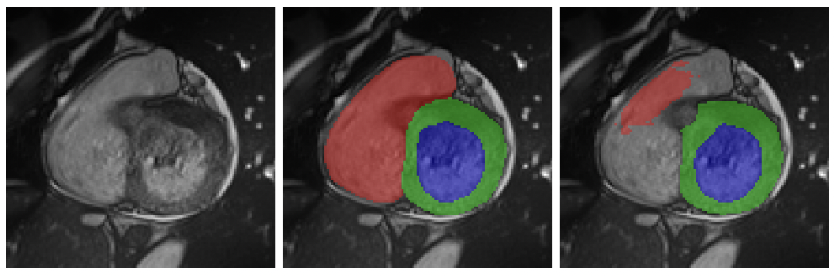 Deep Learning Techniques for Automatic MRI Cardiac Multi-Structures Segmentation and Diagnosis: Is the Problem Solved?
